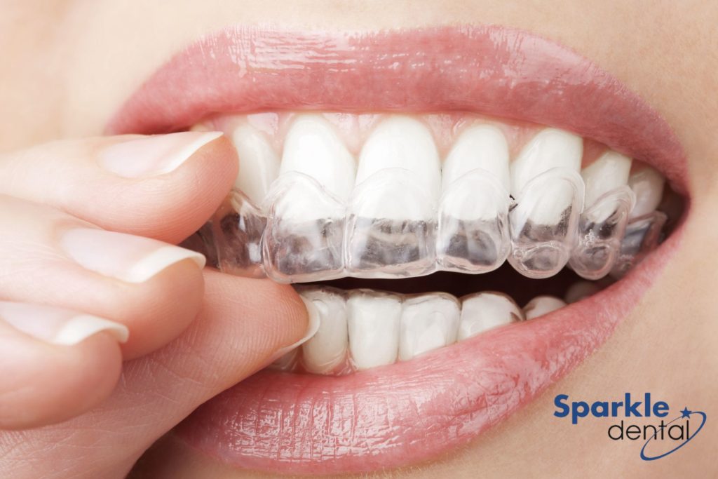 Which one is better? Invisalign vs. Braces - Smile Well Dental