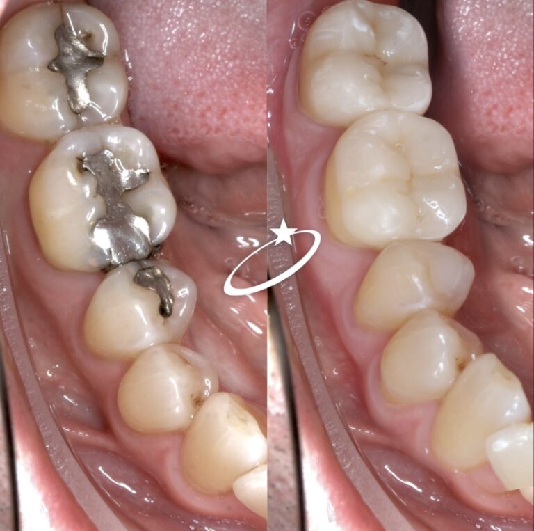 Protecting Heavily Filled Cracked Molar Teeth with Indirect Porcelain ...